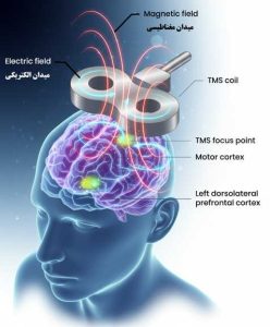 شمای تحریک مغناطیسی مغز rTMS